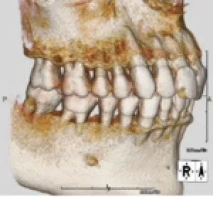 歯周病の診断