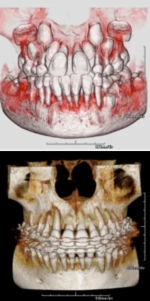 歯の生えてくる方向の診断