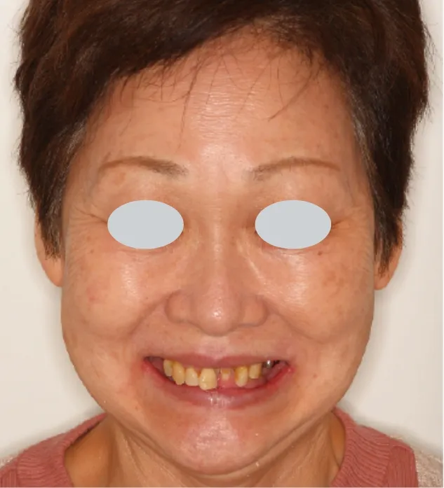 All-on-4 Case 3 術前顔貌写真