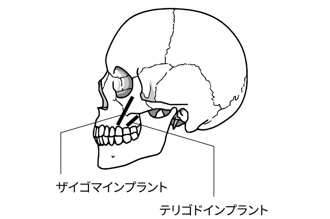 テリゴイドインプラントとザイゴマインプラントの比較説明図