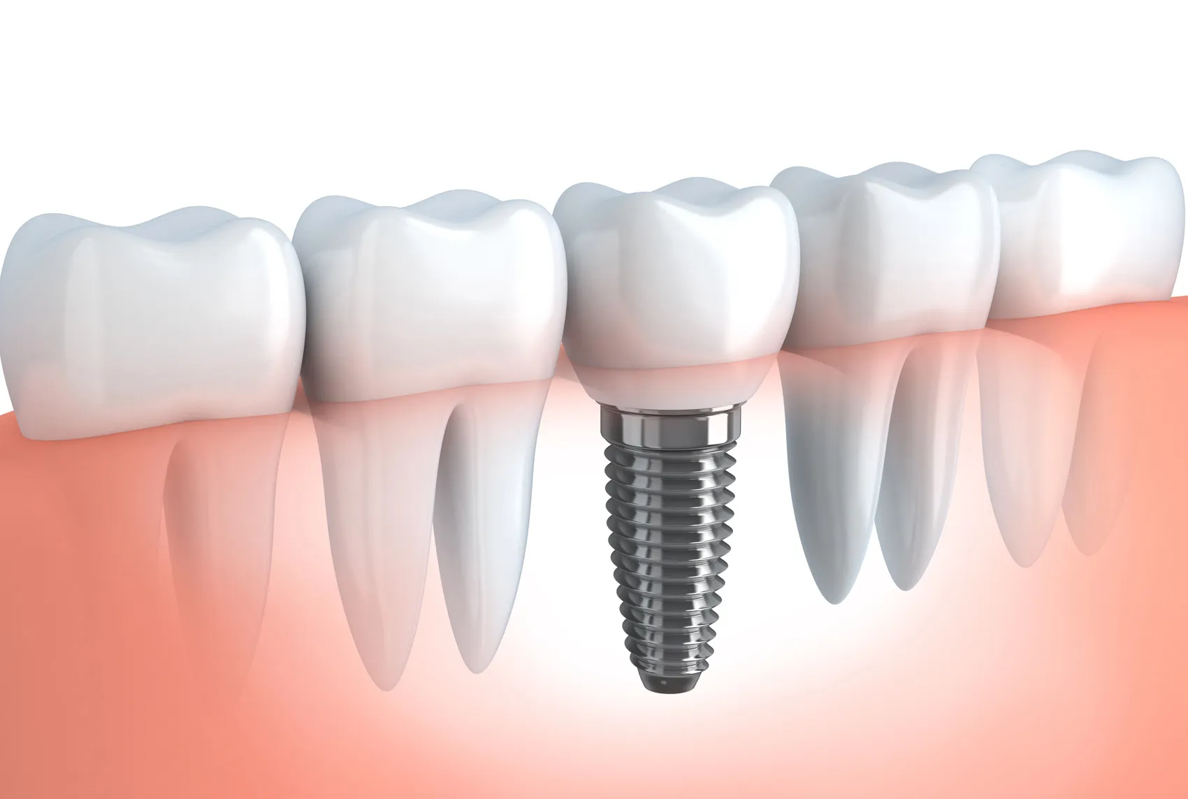 元の健康な歯の状態にもっとも近づく治療法が「インプラント」