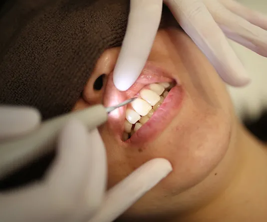 歯石の除去　歯周病の治療　徳島 藍住 斎藤歯科医院